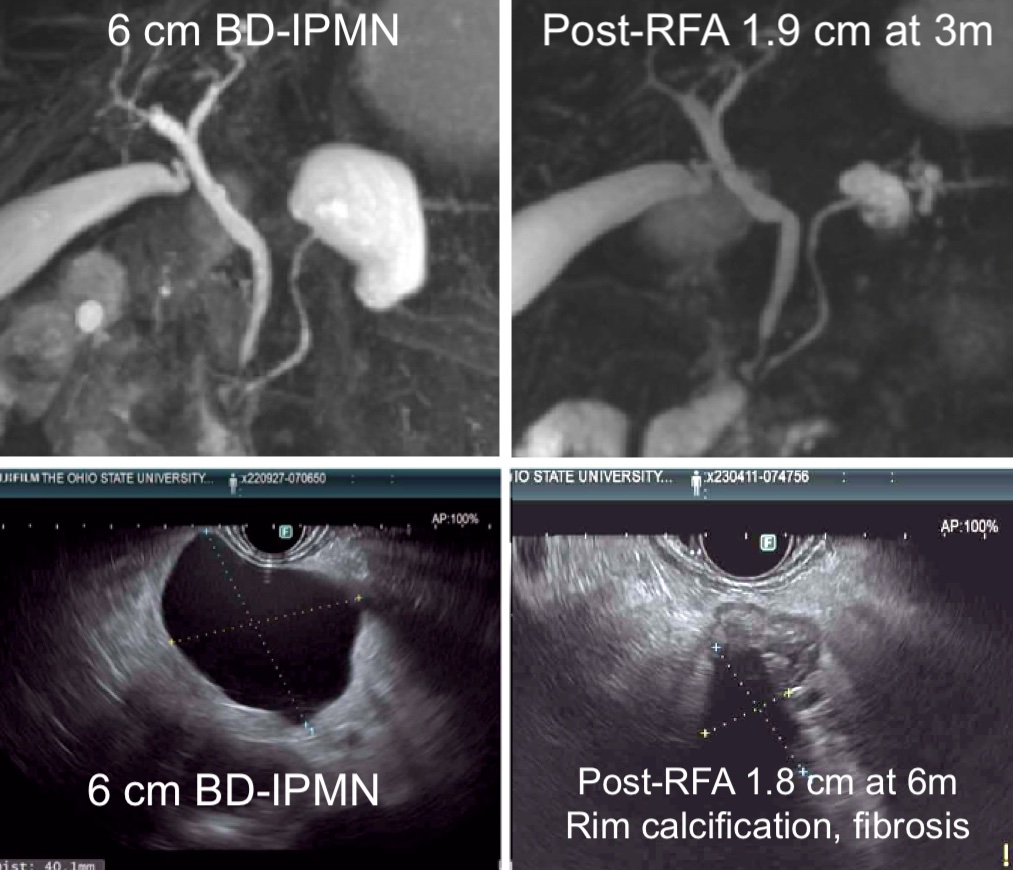 Somashekar Krishna, MD, MPH (@som_krishna) on Twitter photo After 6 months of clearing all regulatory issues - excited to start our prospective study evaluating EUS-RFA in the management of BD-IPMNs.
The ERASE study (E⃣US-guided R⃣FA of PCLs - A⃣ S⃣afety & E⃣fficacy trial)
Pre-trial case (below) with a great response. After 6 months of clearing all regulatory issues - excited to start our prospective study evaluating EUS-RFA in the management of BD-IPMNs.
The ERASE study (E⃣US-guided R⃣FA of PCLs - A⃣ S⃣afety & E⃣fficacy trial)
Pre-trial case (below) with a great response.