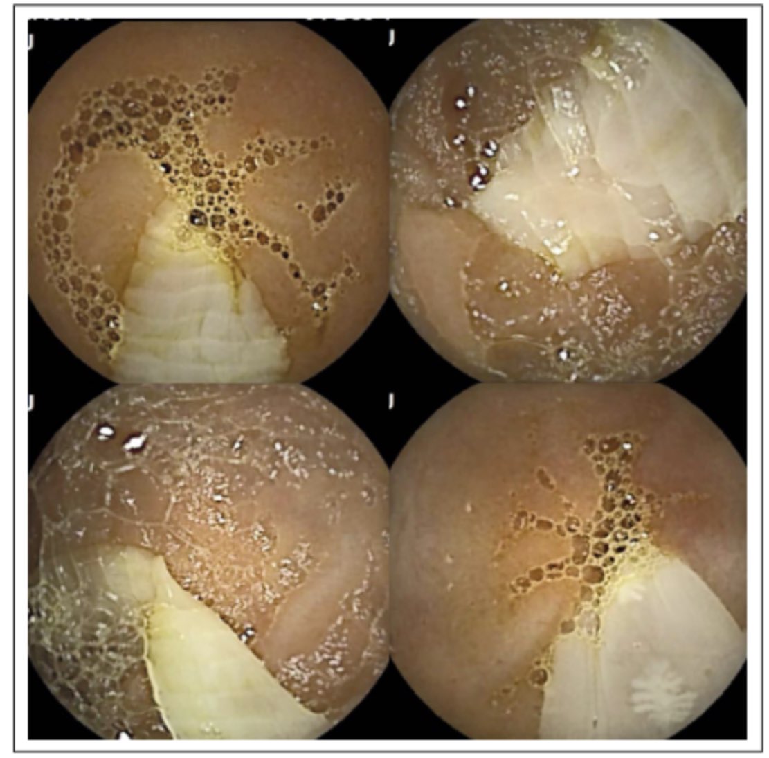 pexkewn's tweet photo. 🪱 What is your diagnosis? This patient has chronic diarrhea and B12 deficiency

📚By Dr. H. Cedrón @hcedron 

✅ Revista Peruana de Gastroenterología 🇵🇪 👍🏻

https://t.co/0qEqQTf7ou https://t.co/zz7oEfsmin
