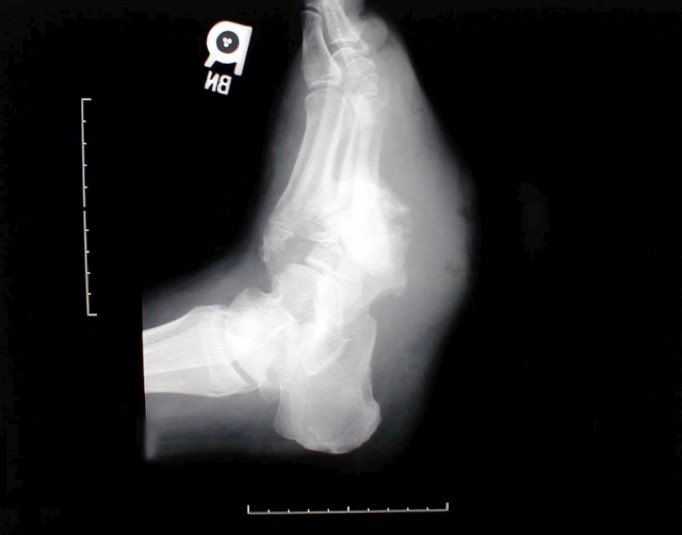BrownJHM's tweet photo. A patient with history of uncontrolled diabetes presented with a worsening ulcer on the foot. What is the likely diagnosis? (Image: Charlie Goldberg) #Medtwitter https://t.co/C2uBM4VOJd