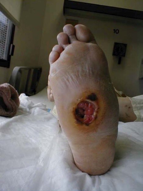 A patient with history of uncontrolled diabetes presented with a worsening ulcer on the foot. What is the likely diagnosis? (Image: Charlie Goldberg) #Medtwitter