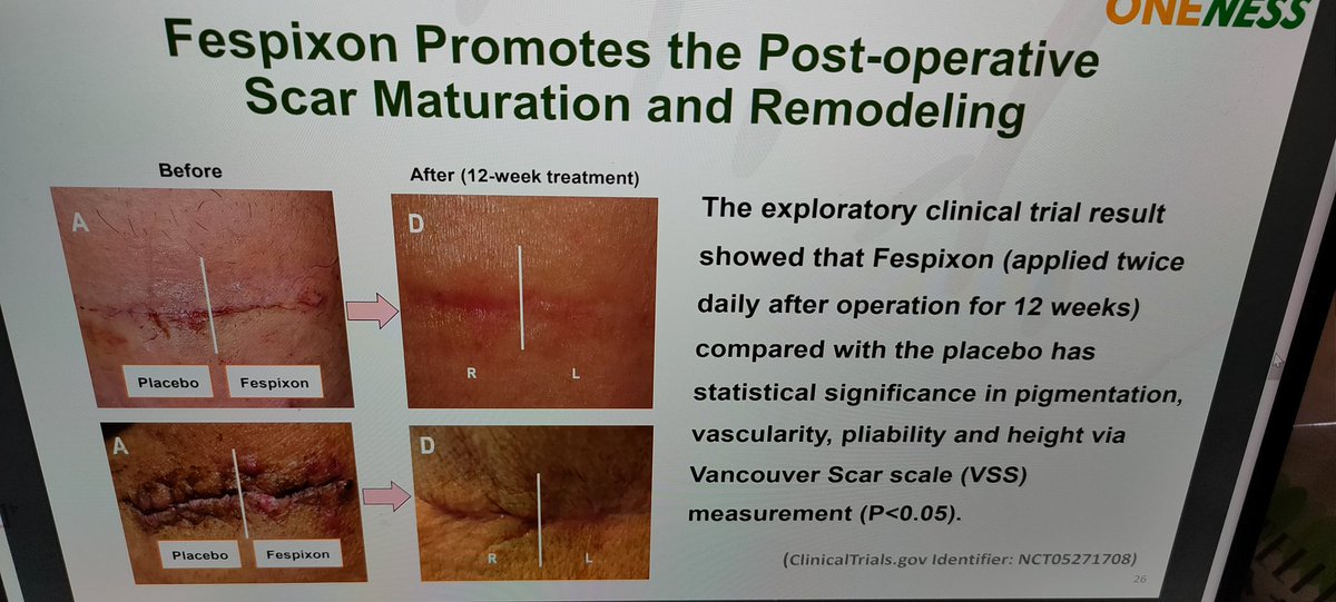 wang1130168's tweet photo. Fespixon（ON101) Promotes the Post-operative Scar Maturation and Remodeling https://t.co/28vt1akCiv