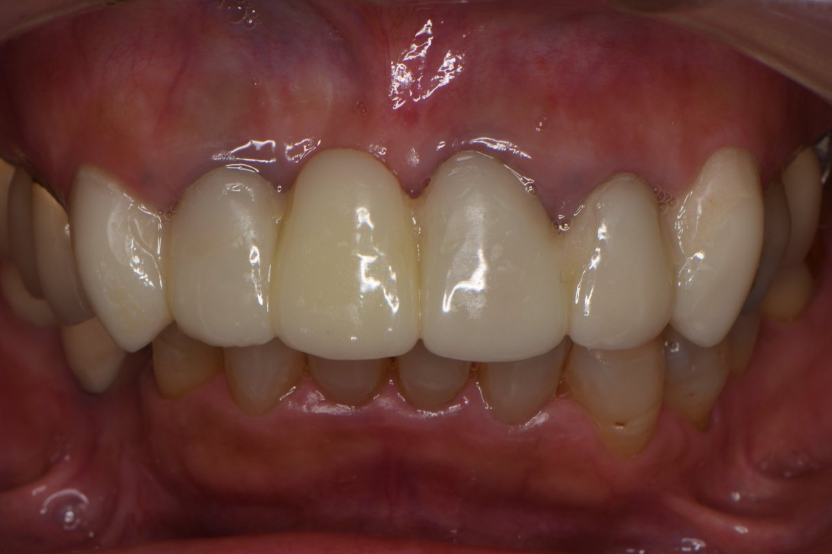 faithdentalate2's tweet photo. これはプレデザインです。
歯のポジションなどはわからないので患者様とイメージを共有するためにやっています。
アプリをダウンロード致しますと3dでどこでも確認できます。
#Predesign
#exocadwebviewer https://t.co/ZFuezJgrpT