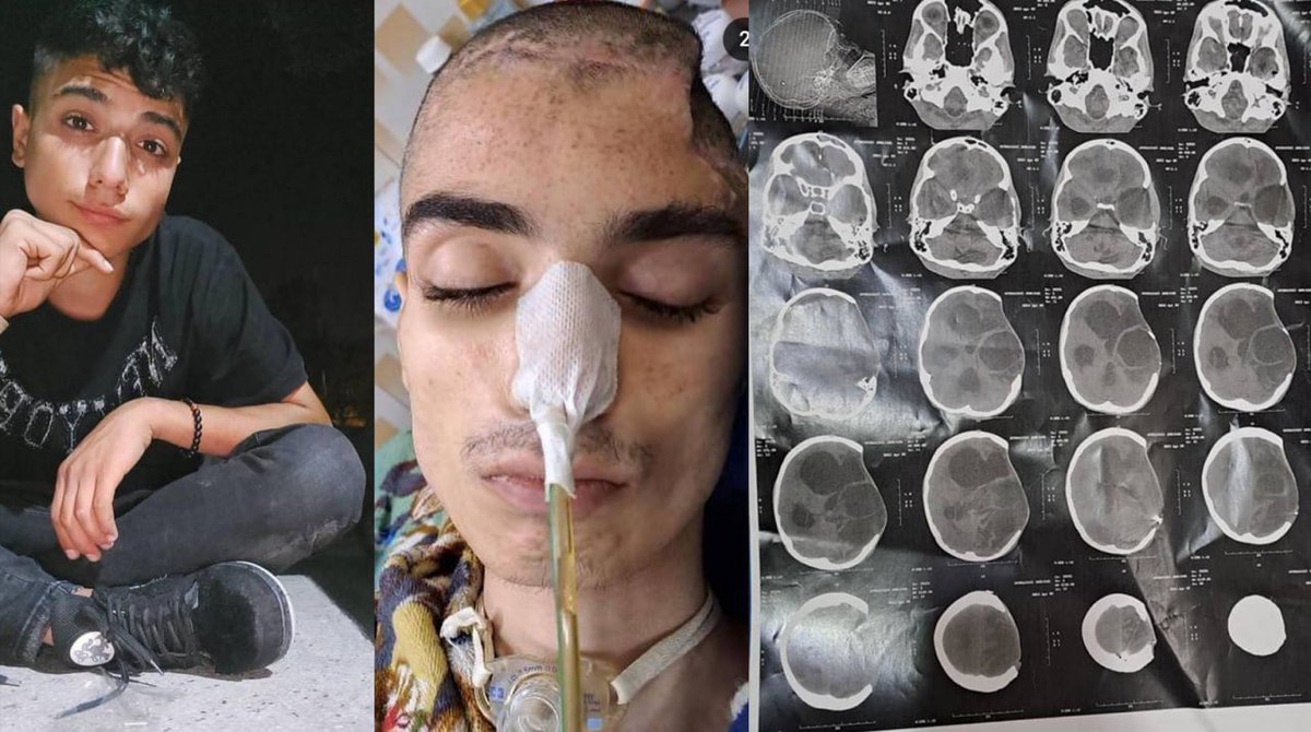 Abulfazl Amir Ataei is a 16-year-old teen who went to the street for freedom. He was paralyzed by the oppressor’s bullets.  

He was with his peers for a civil protest when Khamenei's agents shot him with a tear gas canister from a few feet away. The impact destroyed half of