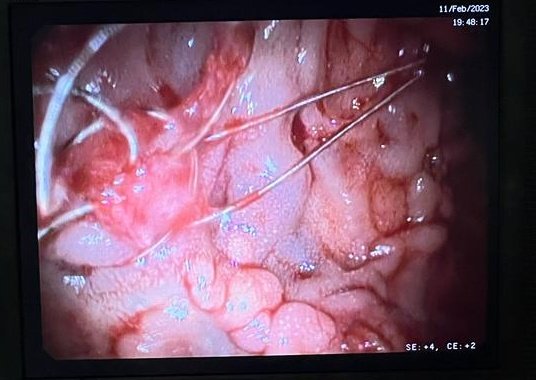 FuadJafarov6's tweet photo. @drkeithsiau ...and its  rupture of duodenal varices coil embolisation https://t.co/LluRvd13wk