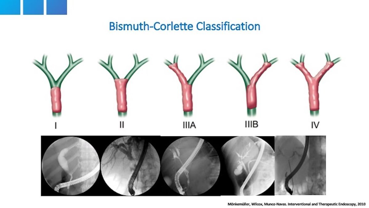 Bismuth-Corlette Classification for Bile Duct Strictures

For more information also check out the lecture on "Endoscopic Management of Proximal Bile Duct Strictures"