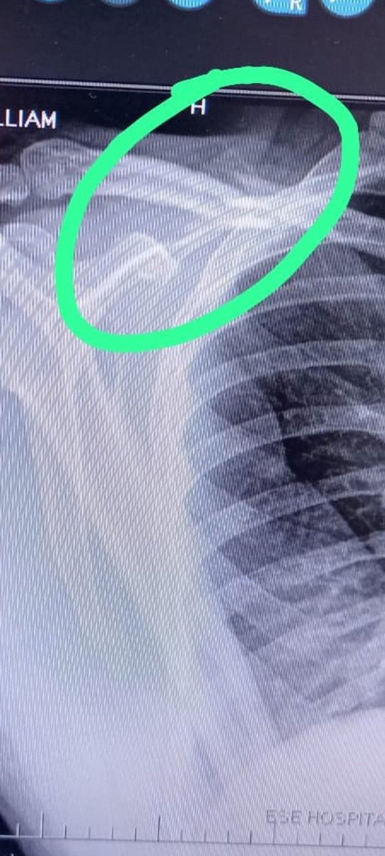 hp81's tweet photo. @Supersalud Buen día Sres Super Salud que las tima que no hay un ente que puede auditar a @epssura como es posible que llevo 9 días esperando por la autorización para cirugía de clavícula y sin respuesta  les coloque una Pqr a @Supersalud pero veo que nadie hace nada al respecto. https://t.co/M5DlY9Fe14