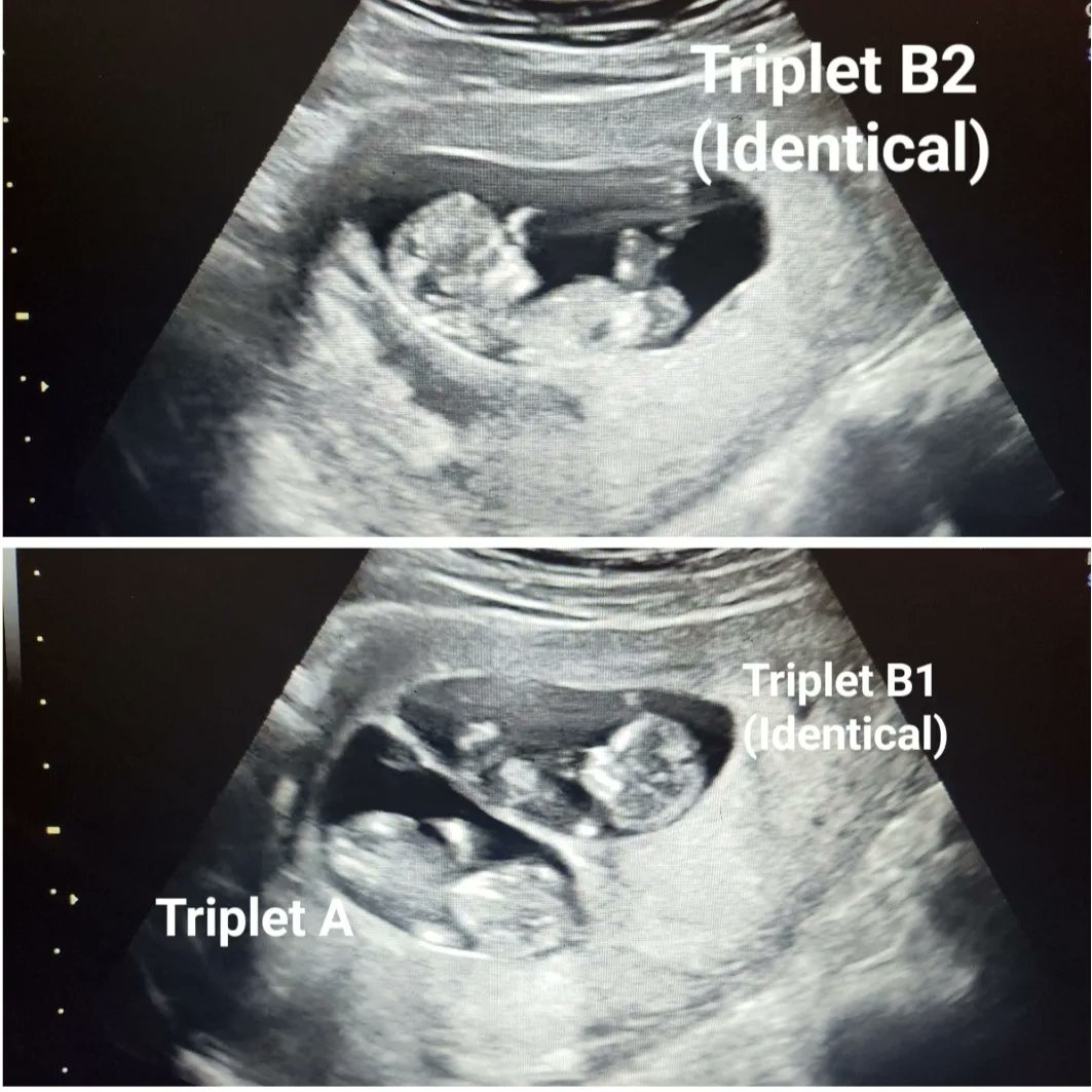 My sister is having 3 babies. THREE!!!!!! WTAF. I'm beyond excited to be the best triple Auntie there ever was. FUCK! ❤🥰❤🥰❤🥰❤👶👶👶