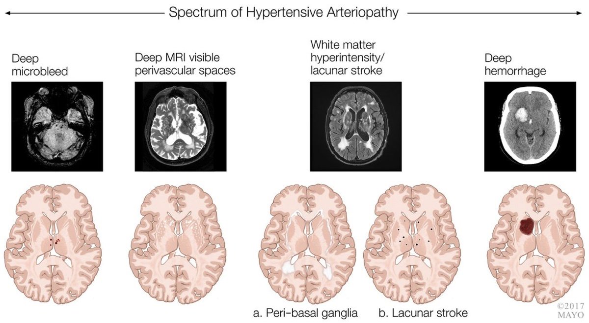 a_charidimou's tweet photo. ⭕️🧠Hypertensive arteriopathy - MRI spectrum

via @ContinuumAAN @j_graffradford
[25(1):147-164, February 2019]

#neurotwitter #Neurology #stroke #Neurosurgery
#FOAMrad #NeuroRad #neuroradiology #radiology #radres #RadEd #FOAMncc #MRI https://t.co/0DYHlgtD0e
