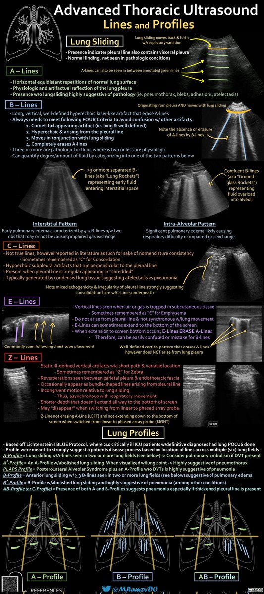 MRamzyDO's tweet image. 🫁 ADVANCED THORACIC #POCUS 🫁
🅰️-Line: Physiologic reflection of pleural line
🅱️-Line: Vertical comet tail artifacts
🦓 Z-line: ill defined artifacts shorter in depth that look like B-lines but arent
🆎Lung profiles can help w/diagnoses
#FOAMed #MedEd @POCUS_Society @srrezaie