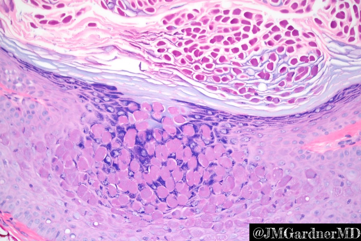 JMGardnerMD's tweet image. Cyst from the thigh of a child. Your diagnosis? Answer here: kikoxp.com/posts/6923. #pathology #pathologists #pathTwitter #dermpath #dermatology #dermatologia #dermtwitter