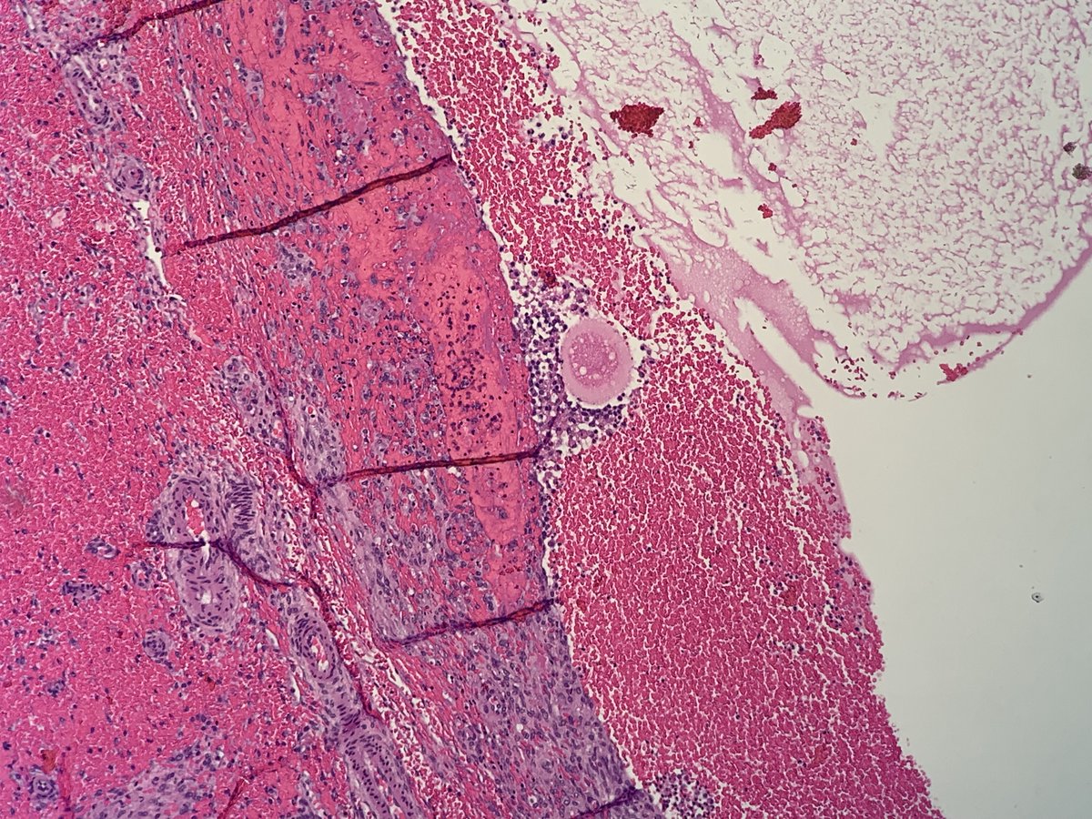 ecarrascal's tweet image. Catastrophe! Adnexal torsion! Egg in formation knocked down