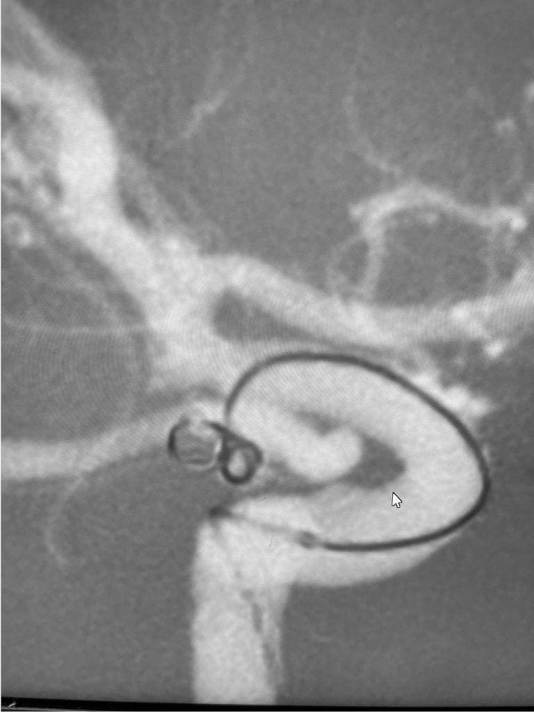 ChiragIR's tweet photo. Complex aneurysm at communicating ICA with two lobes. Choroidal emanating from superior lobe and PCoA from inferior lobe 🙀 . Treated these as two separate aneurysms with unassisted coiling (No 🎈 ) with preservation of both precious vessels. #minimalist #neurointervention https://t.co/GWItpGEQDE
