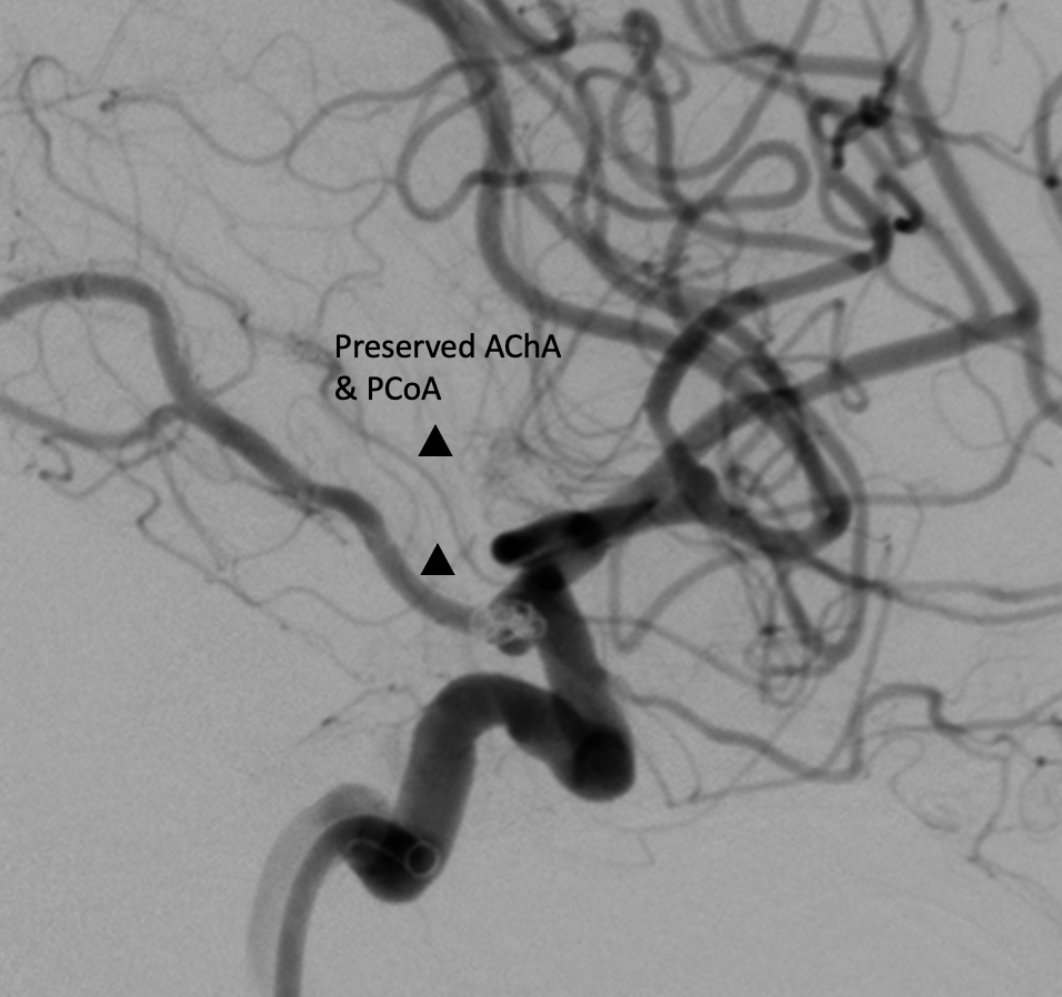 ChiragIR's tweet photo. Complex aneurysm at communicating ICA with two lobes. Choroidal emanating from superior lobe and PCoA from inferior lobe 🙀 . Treated these as two separate aneurysms with unassisted coiling (No 🎈 ) with preservation of both precious vessels. #minimalist #neurointervention https://t.co/GWItpGEQDE