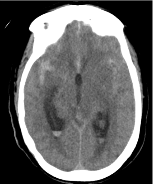 ChiragIR's tweet photo. Complex aneurysm at communicating ICA with two lobes. Choroidal emanating from superior lobe and PCoA from inferior lobe 🙀 . Treated these as two separate aneurysms with unassisted coiling (No 🎈 ) with preservation of both precious vessels. #minimalist #neurointervention https://t.co/GWItpGEQDE