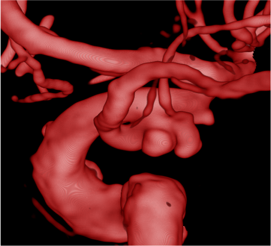ChiragIR's tweet photo. Complex aneurysm at communicating ICA with two lobes. Choroidal emanating from superior lobe and PCoA from inferior lobe 🙀 . Treated these as two separate aneurysms with unassisted coiling (No 🎈 ) with preservation of both precious vessels. #minimalist #neurointervention https://t.co/GWItpGEQDE