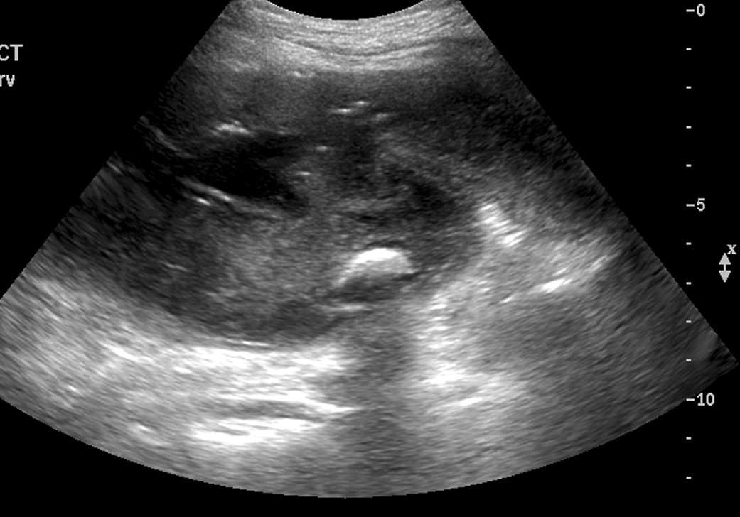 JoseLuisdelCura's tweet photo. La colecistitis es una de las urgencias más frecuentes en los hospitales. La #radiología es uno de los pilares en su diagnóstico (el diagnóstico se basa en la ecografía) ... y en su tratamiento.
Voy a hablar de la colecistostomía, un procedimiento cada vez más frecuente https://t.co/LwQDUZQRwd