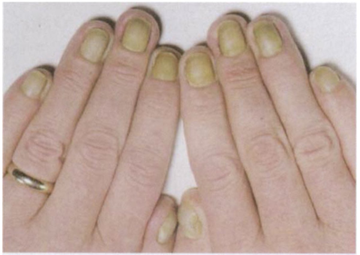 You notice this in a patient with ascites and breathlessness. What’s the diagnosis?