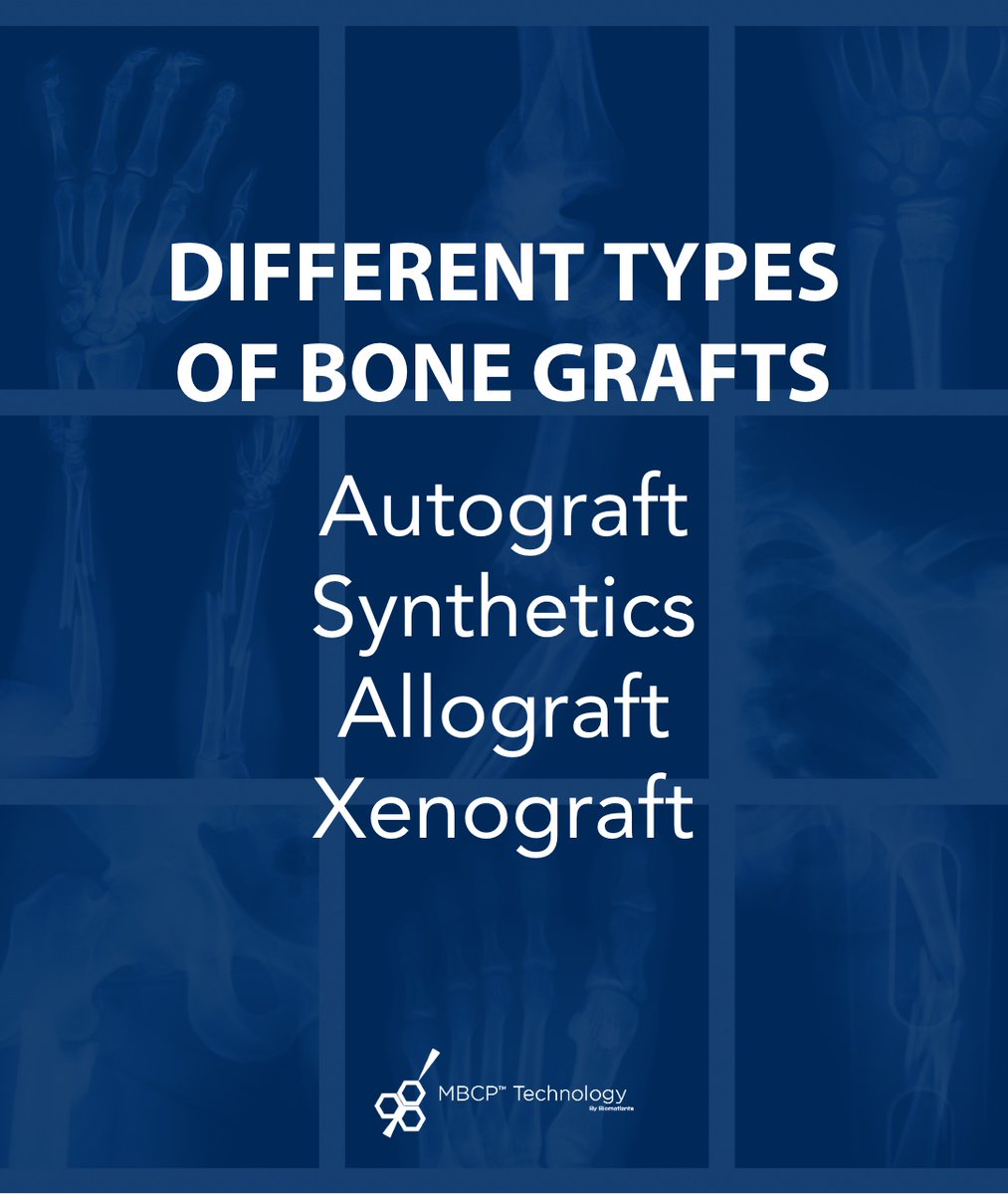 Did you know there are different types of bone grafts? 

Autograft - uses a sample of your bone tissue
Synthetics - uses artificially produced materials
Allograft - uses bone tissue from another person
Xenograft - uses tissue from a donor of another species