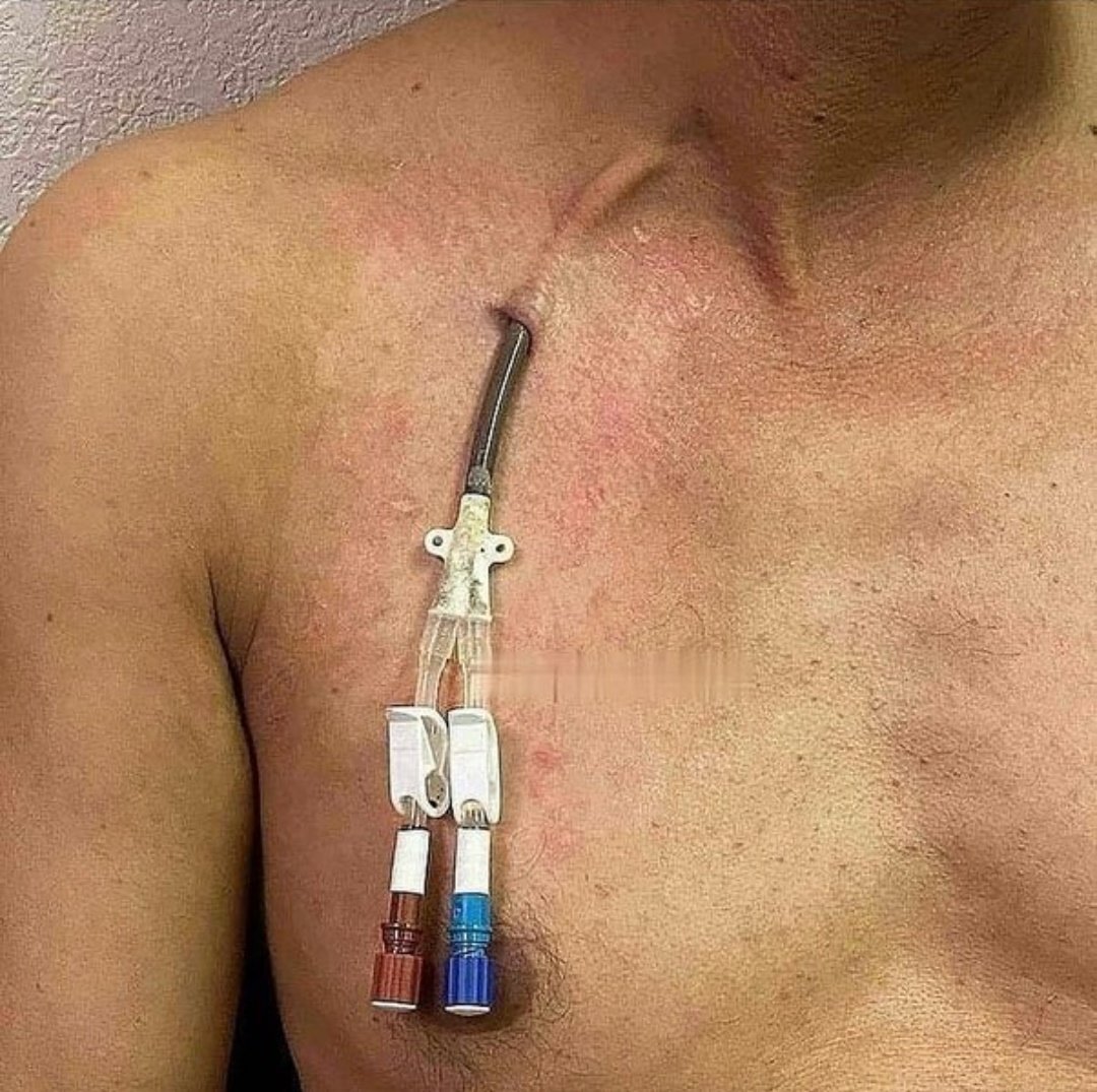 LeContempIateur's tweet image. Savez-vous que pendant la dialyse, le sang est entièrement  retiré du corps par le tube rouge, passe à travers l'appareil de dialyse, puis est réintroduit dans le corps par le tube bleu ?

Ce processus est répété pendant 4 à 5 heures, pendant que le patient reste immobile dans…