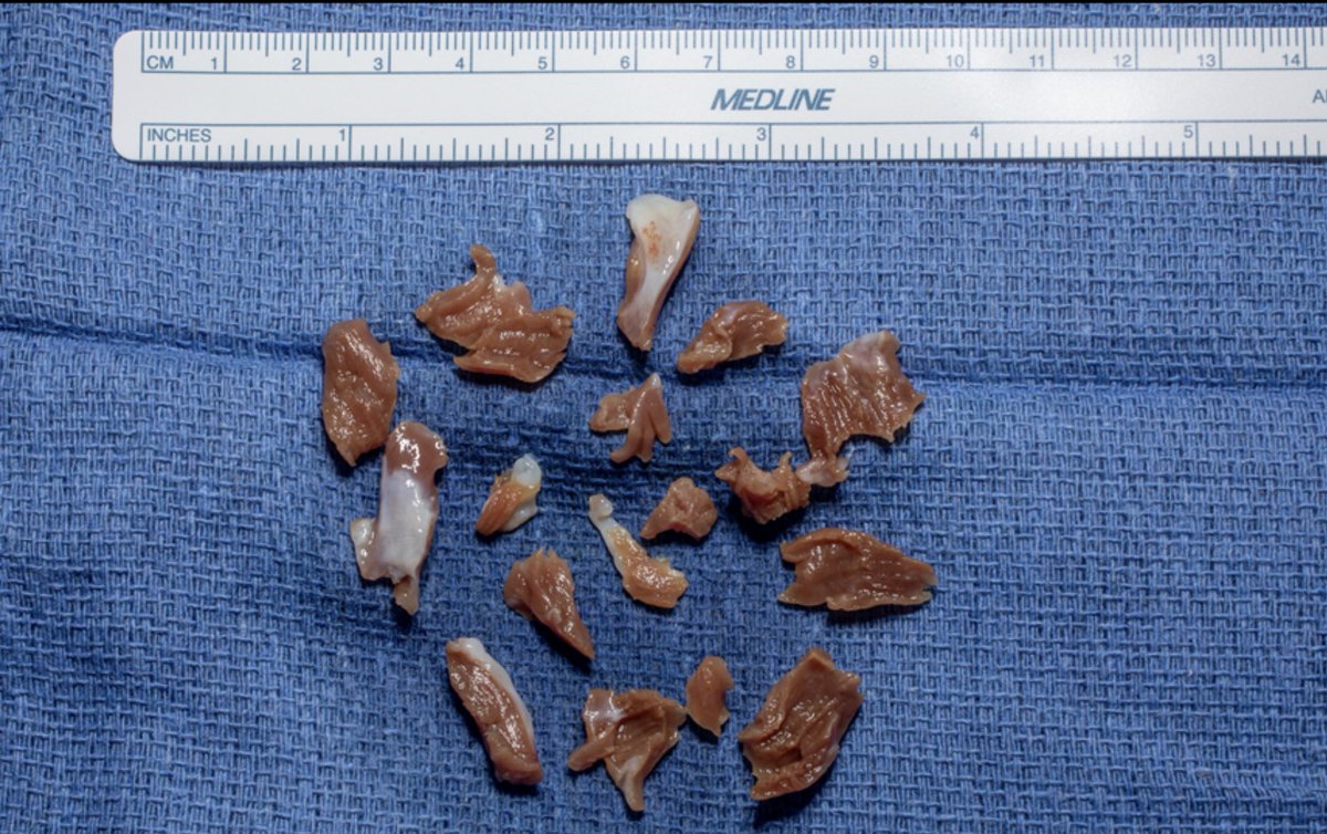 Myectomy specimen(s). I use a #10 knife blade with the aortotomy carried very low into the non-coronary sinus…what do you use?