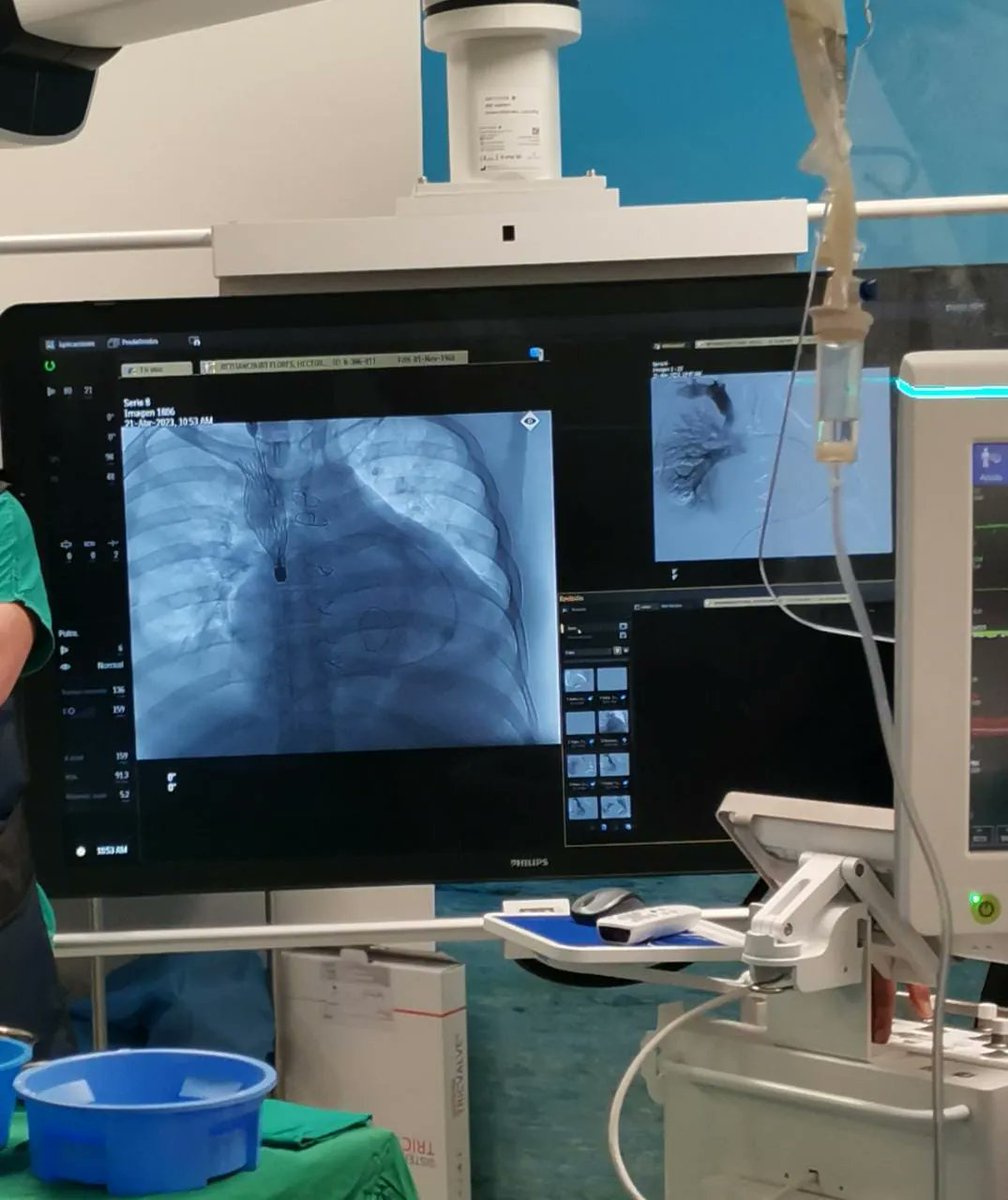 Médicos panameños realizaron un implante de válvulas tricúspides en el corazón, el primero en Centroamérica.

Este procedimiento ayuda a restablecer el flujo sanguíneo y mejora la calidad del paciente. <a href="/CSSPanama/">CSSPanama</a> #TReporta