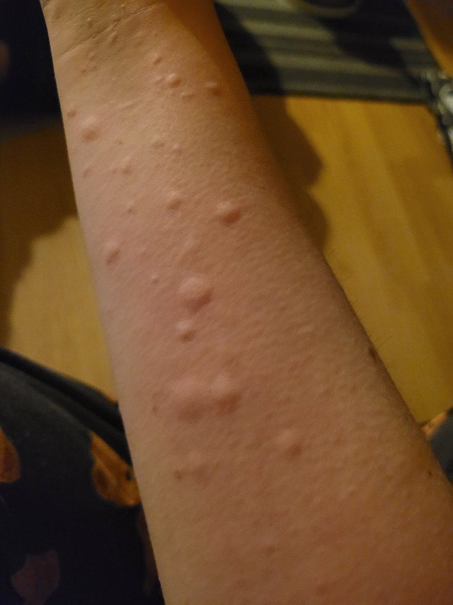 The redness has gone down and the itching has stopped. Thank the lord for antihistamines. Going to get in touch with GP tomorrow and ask to be put back on my meds. All will be ok, it's calming down now 🙏 #allergicreaction #spontaneousurticaria