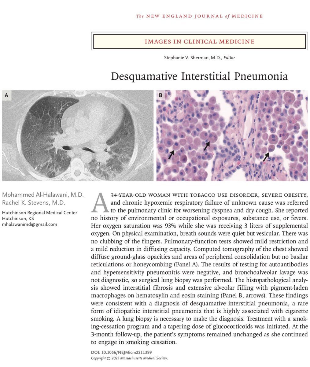 Mauricio Ambriz on Twitter Neumonía intersticial descamativa N Engl J Med DOI