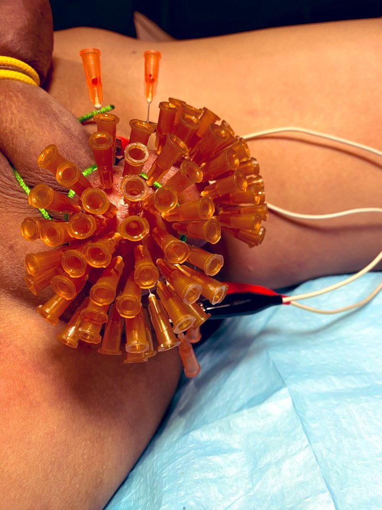 穿刺84針+電擊清單達成

下次挑戰破百

#NeedlePlay #cbt #ballbusting #穿刺 #蛋蛋穿刺 #睪丸穿刺