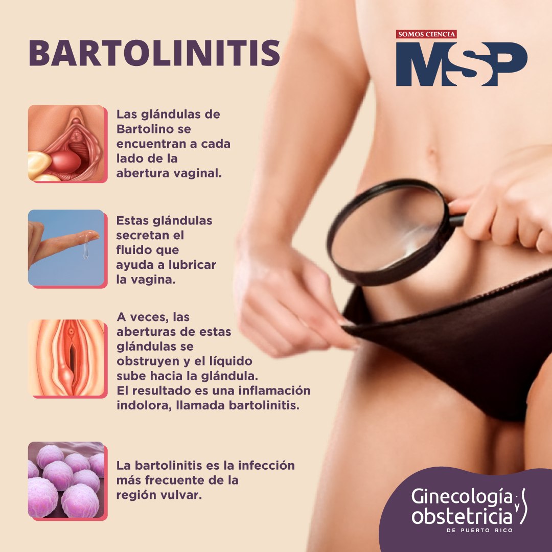 Salud_en_casa1's tweet photo. La #bartolinitis puede llegar a confundirse con un #absceso de Bartolino, que es una acumulación de pus en una de las #glándulas. ¡Comparte! https://t.co/ZzLWg7j8su