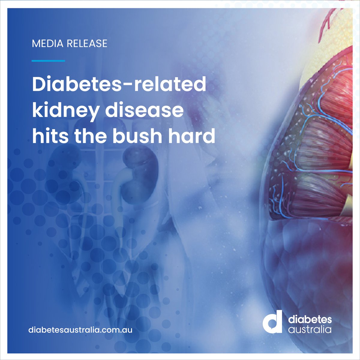 DiabetesAus's tweet image. Regional and remote areas are reporting nearly 4 times the rate of hospitalisations than people living in Northern Sydney. @DiabetesAus CEO Justine Cain says the findings point to an urgent need for a National #Diabetes #Kidney Disease Screening Program.
diabetesaustralia.com.au/news/the-bush-…