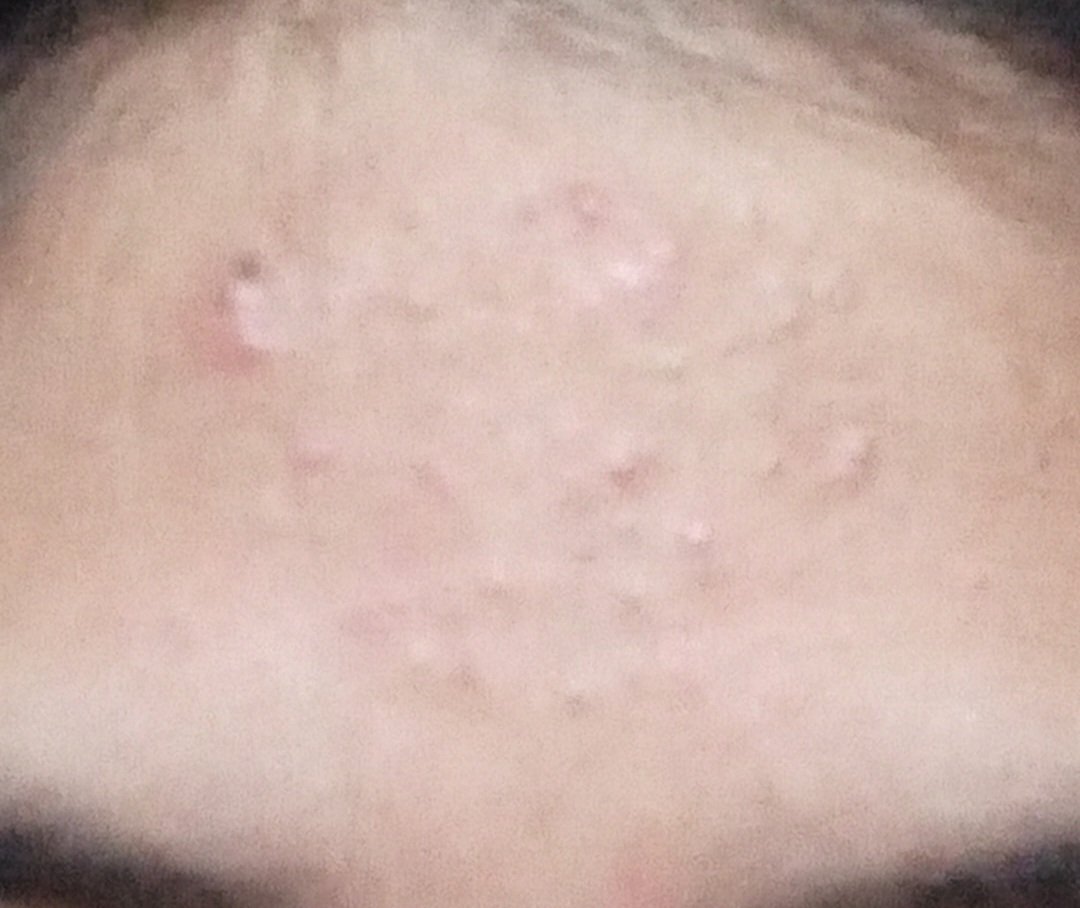 `•°💫Hello moots👋
So this is my first tweet. Disini aku mau share beberapa skincare yang aku pakai saat mukaku sedang bruntusan. Bisa kalian liat foto before &amp; afternya ya!

*Skin type aku normal to oily°•