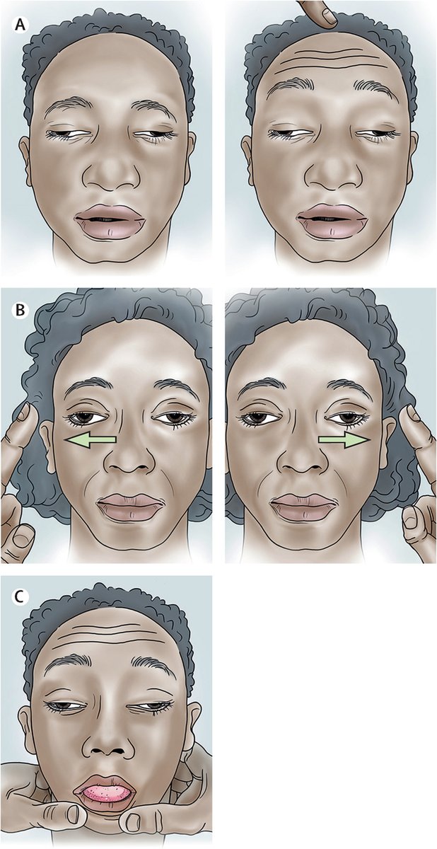 With annual incidence likely to be 5 million bites, and mortality exceeding 150,000 deaths, the public health importance of #snakebite envenoming is increasing.

A Seminar details the clinical aspects alongside treatment in low-resource settings: hubs.li/Q01MsPLv0