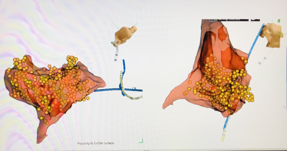 jonascooperEP's tweet photo. I saw a patient, ablated elsewhere for CTI flutter… this is the map that doctor made.  I am at a loss for words.  Help  #EPeeps  Describe this ‘CTI line’? https://t.co/fISOXiEh7d