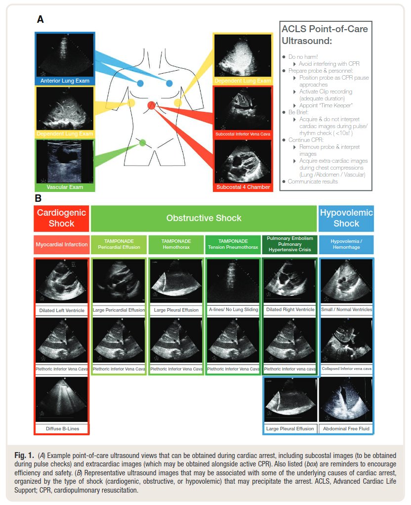 Today's Paper of the Day is by Jonathan Paul on point-of-care ultrasound in cardiac arrest
criticalcarereviews.com/latest-evidenc…

Join us to read 1 paper per day and stay up-to-date as we cover the spectrum of critical care across 2023
