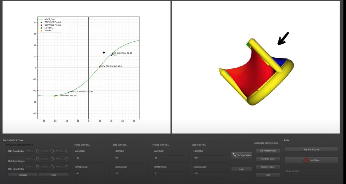 Exciting news! We successfully performed doppio-BASILICA ✂️ on a surgical valve with radiolucent posts using our very own prototype software, BASILICA-Assist 👨‍💻. This innovative software allowed us to simulate the current orientation of the valve in real-time. #CardioTwitter