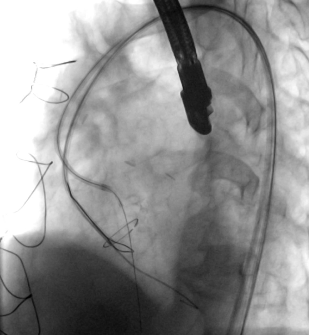docsuleman's tweet photo. Exciting news! We successfully performed doppio-BASILICA ✂️ on a surgical valve with radiolucent posts using our very own prototype software, BASILICA-Assist 👨‍💻. This innovative software allowed us to simulate the current orientation of the valve in real-time. #CardioTwitter https://t.co/fzlRE29cxr