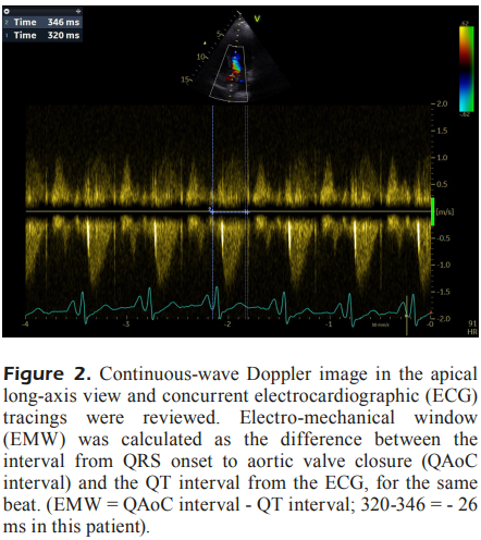 HenkvanderLin12's tweet image. Negativity of the #electromechanicalwindow: relation to frequent premature ventricular complexes. europeanreview.org/wp/wp-content/…
