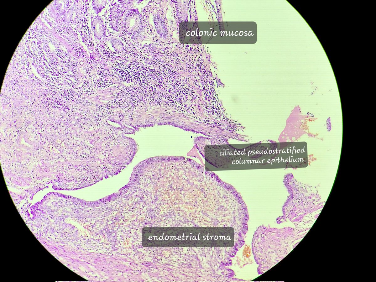 padmapathology1's tweet image. #oneimagediagnosis 
#NotSoBoringAppendix 
Endometriosis of the appendix
@varunksingh