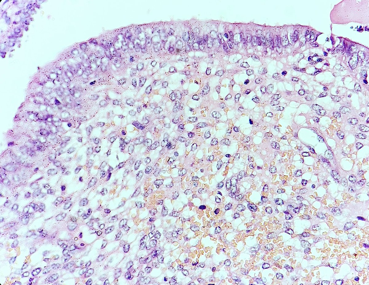 padmapathology1's tweet image. #oneimagediagnosis 
#NotSoBoringAppendix 
Endometriosis of the appendix
@varunksingh