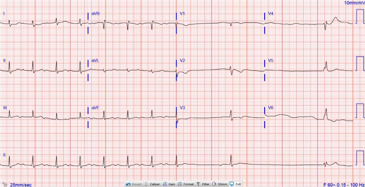 A 34-year-old female living in the Northeastern U.S. p/w 3 weeks of cough, dizziness, dyspnea, headache &amp; chest pressure. Hx of cough after cleaning a parrot cage at the pet store where she worked. Initial EKG below. Labs &amp; imaging benign. What’s the likely diagnosis? <a href="/PMHTran/">Paul Tran</a>
