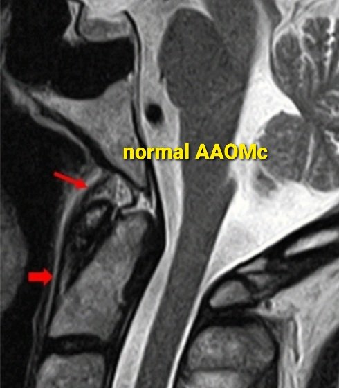 PeteFiesterMD's tweet image. 🤷‍♂️ Why care about Anterior Atlanto-Occipital Membrane (AAOM) tears? 

✅  Routinely visible on #MRI

✅  Tears in 3️⃣ distinct patterns

✅  Presents w/ CCJ prevertebral effusion on #CT &amp;amp; major CCJ lig. injuries on #MRI 

➡️ rdcu.be/dawhs 

#NeuroRad #NeuroSurgery #Spine