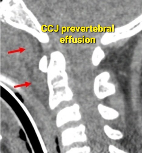 PeteFiesterMD's tweet image. 🤷‍♂️ Why care about Anterior Atlanto-Occipital Membrane (AAOM) tears? 

✅  Routinely visible on #MRI

✅  Tears in 3️⃣ distinct patterns

✅  Presents w/ CCJ prevertebral effusion on #CT &amp;amp; major CCJ lig. injuries on #MRI 

➡️ rdcu.be/dawhs 

#NeuroRad #NeuroSurgery #Spine
