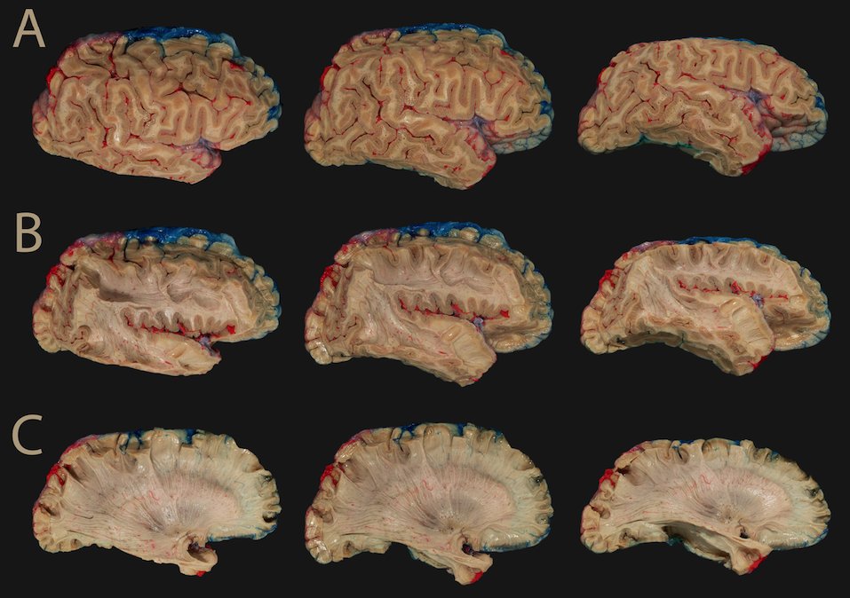 AnatomieTours's tweet photo. Our novel #method assesses the #arterial distribution of the deep #cerebral #whitematter. It does not require any sophisticated equipment and may be performed in almost every #anatomy lab. @NaturePortfolio

https://t.co/mYtXcFk9Io https://t.co/H4RTu43Yhi