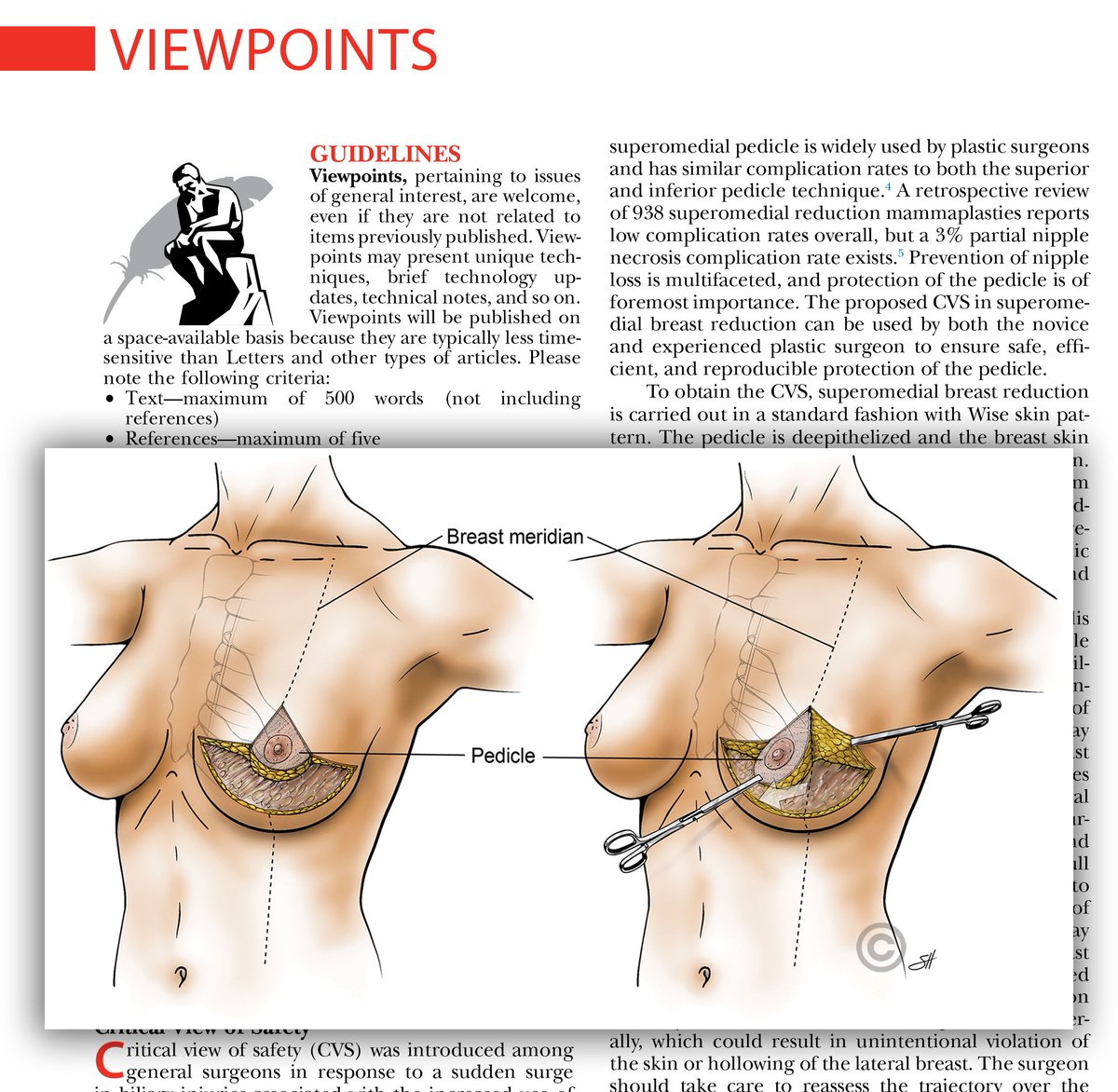 Plastic and Reconstructive Surgery (@prsjournal) on Twitter photo Read about, "Superomedial Pedicle Breast Reduction: The Critical View of Safety" by Skochdopole, Grome, Jiang, <a href="/dredwardreece/">Edward Reece</a>, <a href="/joshua_vorst/">Joshua Vorstenbosch</a>, and <a href="/WinocourMD/">Sebastian Winocour, MD, MBA, FACS</a>
Read it today: bit.ly/SuperomedialBr… Read about, "Superomedial Pedicle Breast Reduction: The Critical View of Safety" by Skochdopole, Grome, Jiang, <a href="/dredwardreece/">Edward Reece</a>, <a href="/joshua_vorst/">Joshua Vorstenbosch</a>, and <a href="/WinocourMD/">Sebastian Winocour, MD, MBA, FACS</a>
Read it today: bit.ly/SuperomedialBr…