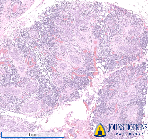 JHUPath's tweet photo. An 80 year old woman requires surgical resection of an infiltrative submandibular mass.
#Pathtwitter #Pathmatch23 #Path2Path https://t.co/Wsn60gKjsc