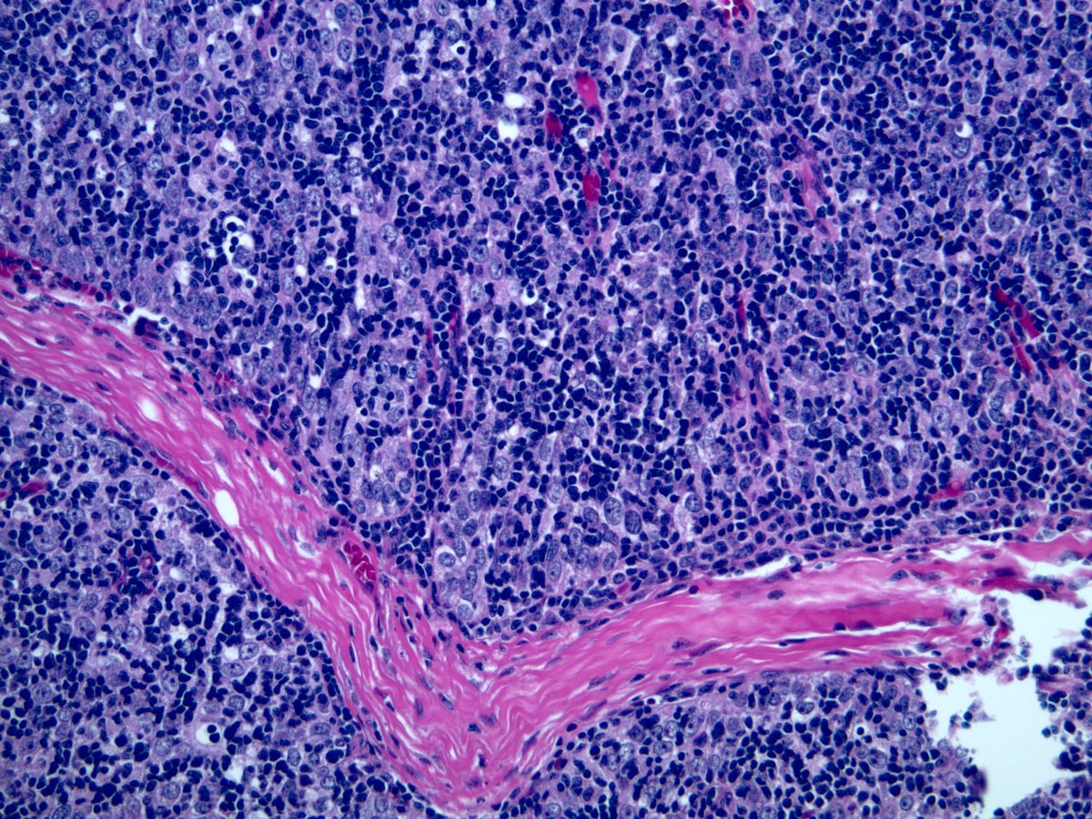 Jerad Gardner, MD on Twitter "RT smlungpathguy Thymoma is a neoplasm