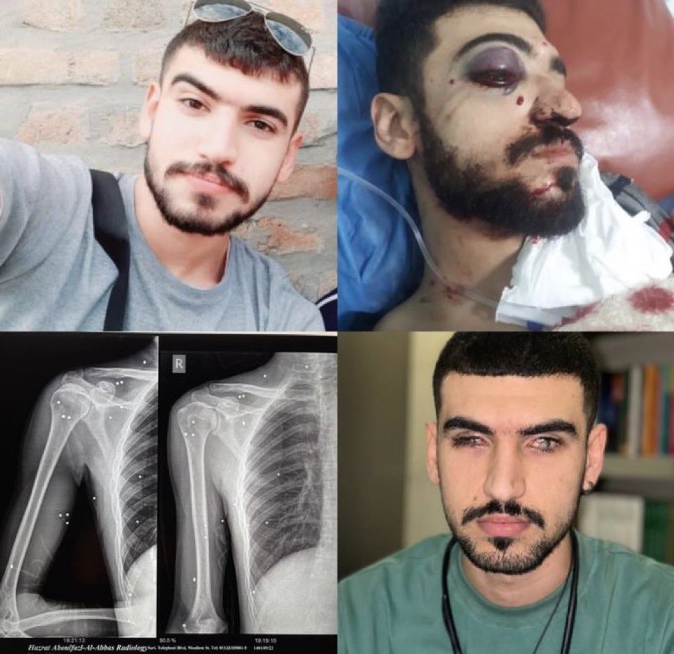 مارو ببخش که چشماتو به خاطر ما از دست دادی ولی ما سکوت کردیم😔
#متین_منانی
#مهسا_امینی