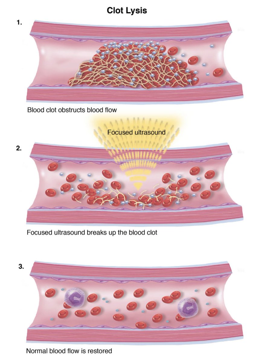 Could Magnetic resonance-guided FUS (MRgFUS) sonolysis be useful for distal thrombi?
From doi.org/10.1007/13311-…