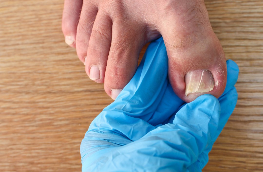 Florida podiatrist Dr. Lawrence J. Kales at Pasco-Hernando Foot and Ankle treats two of the most common toenail conditions: fungal infections and ingrown toenails. If you experience either of these conditions, you'll want to read this post: ow.ly/UJMx50NQy0J