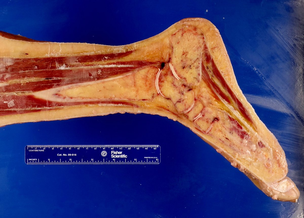 Osteosarcoma of femur, extending into adjacent muscle and soft tissue.

Last pic just a cross section of foot for some anatomy!

#pathology #grosspath